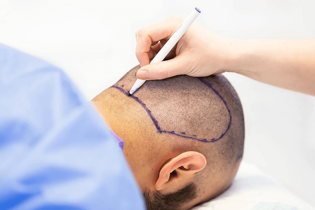 All About Dhi Hair Transplant Method